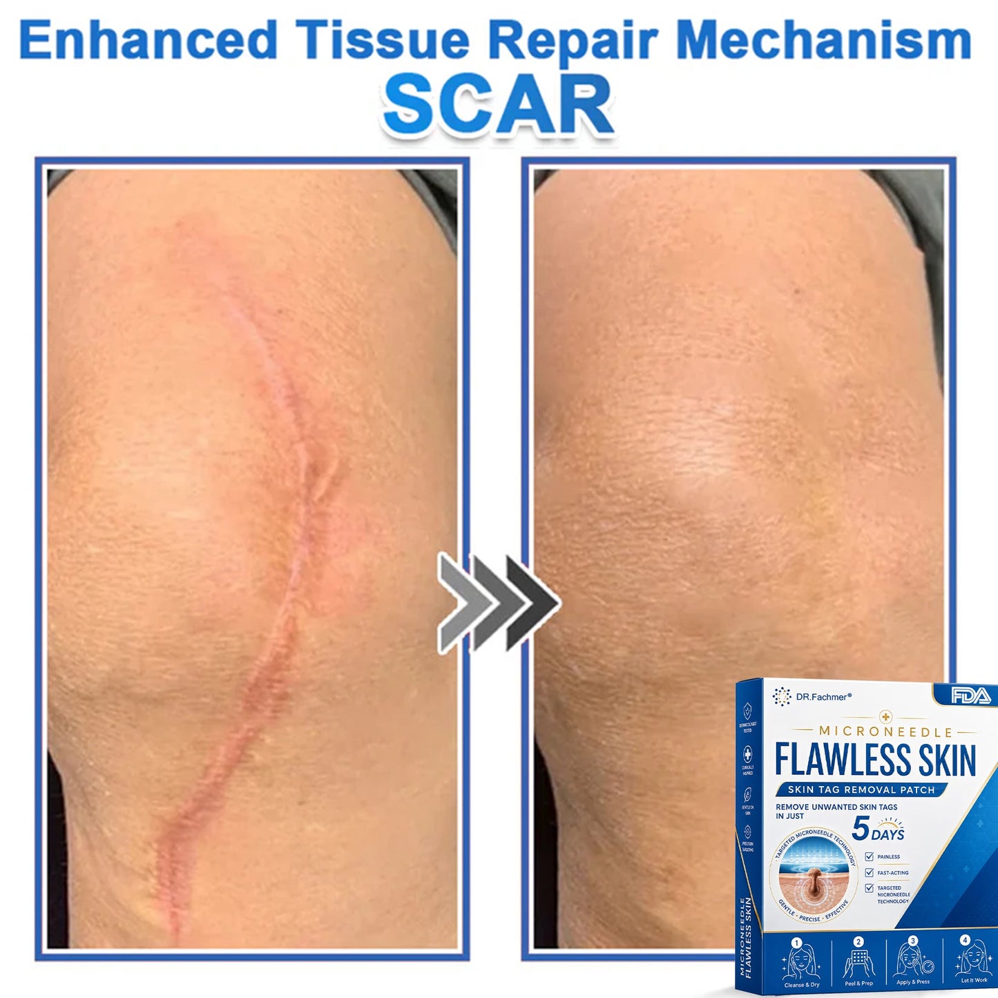🩹 DR.Fachmer® 2-in-1 Microneedle & Hydrocolloid Patch | Raised Moles,Acne, Flat Warts & Skin Tags Remover | Improves Wrinkles, Scars & Blemishes | Invisible Pimple Patches for Face & Body