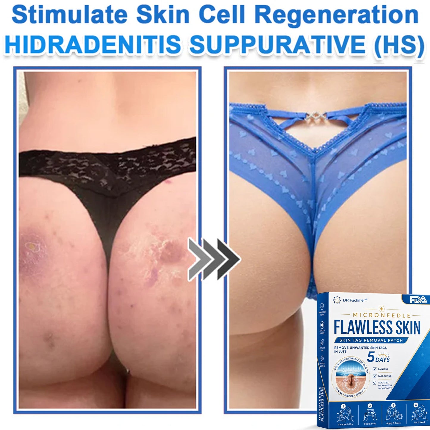 🩹 DR.Fachmer® 2-in-1 Microneedle & Hydrocolloid Patch | Raised Moles,Acne,  Flat Warts & Skin Tags Remover | Improves Wrinkles, Scars & Blemishes | Invisible Pimple Patches for Face & Body
