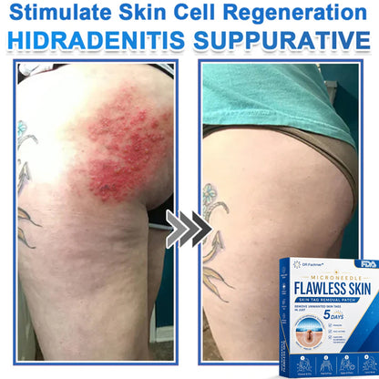 🩹 DR.Fachmer® 2-in-1 Microneedle & Hydrocolloid Patch | Raised Moles,Acne,  Flat Warts & Skin Tags Remover | Improves Wrinkles, Scars & Blemishes | Invisible Pimple Patches for Face & Body