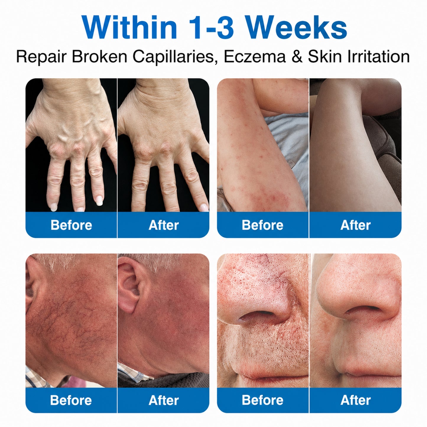 👨‍⚕️✅💙GFOUK® VeinRepair Microneedle Patch Roll⚡Instant Relief, Long-Term Results
