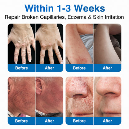 👨‍⚕️✅💙GFOUK® VeinRepair Microneedle Patch Roll⚡Instant Relief, Long-Term Results