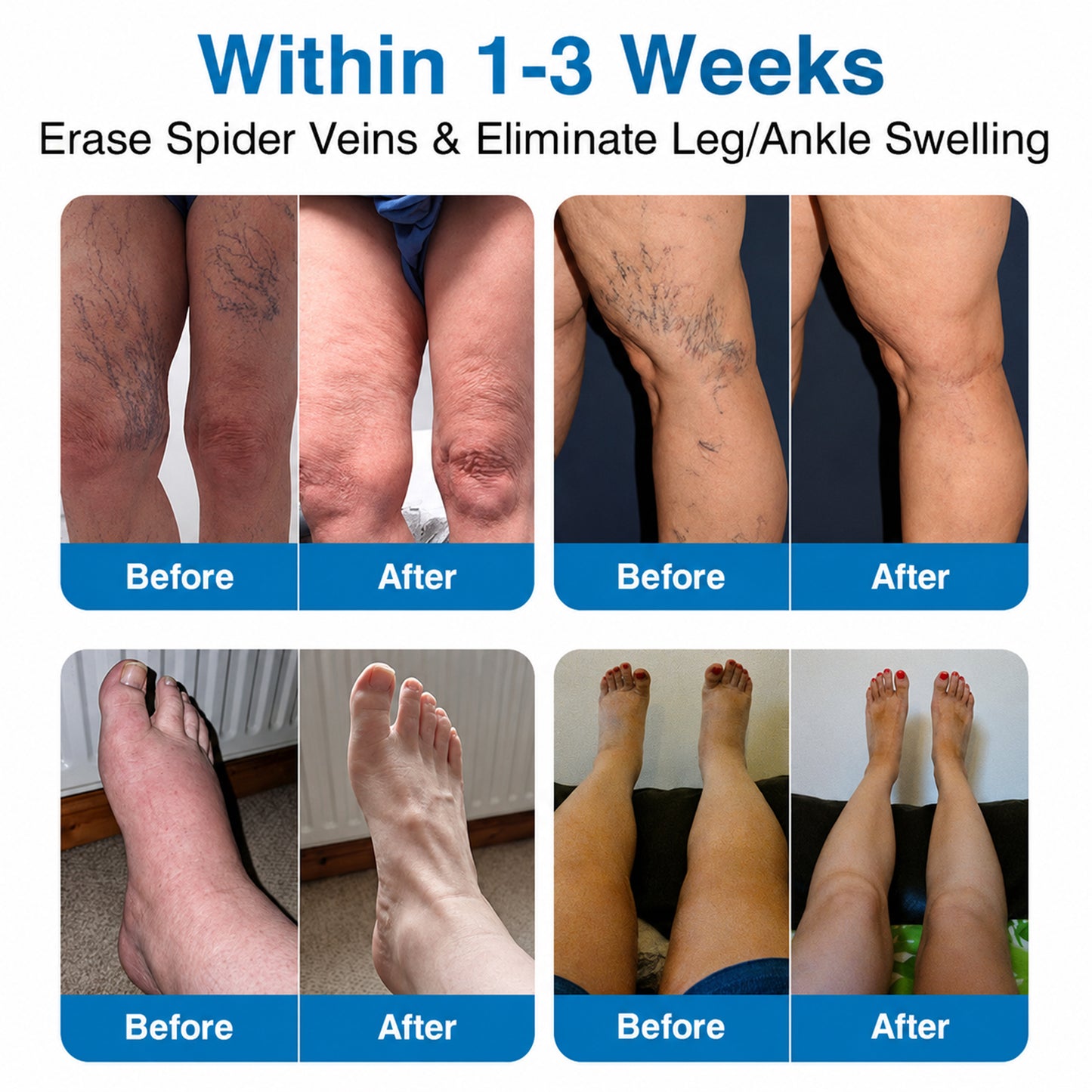 👨‍⚕️✅💙GFOUK® VeinRepair Microneedle Patch Roll⚡Instant Relief, Long-Term Results