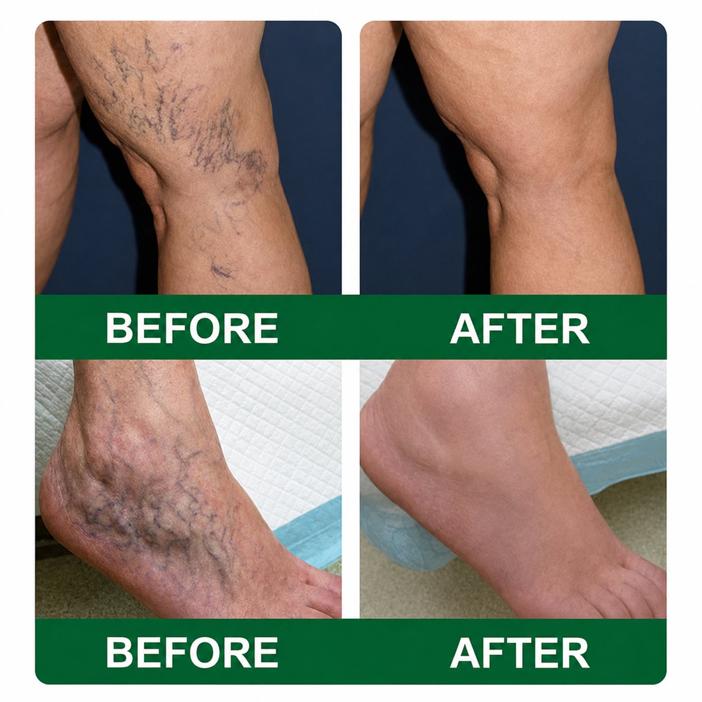 🩹DR.Fachmer® Vein Ease Microneedle Care Patch(For Spider Veins, Varicose Veins, Swelling & Leg Fatigue) - Last Day Promotion 50% OFF
