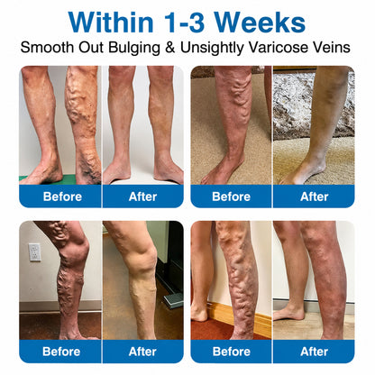 👨‍⚕️✅💙GFOUK® VeinRepair Microneedle Patch Roll⚡Instant Relief, Long-Term Results
