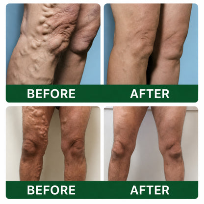 🩹DR.Fachmer® Vein Ease Microneedle Care Patch(For Spider Veins, Varicose Veins, Swelling & Leg Fatigue) - Last Day Promotion 50% OFF