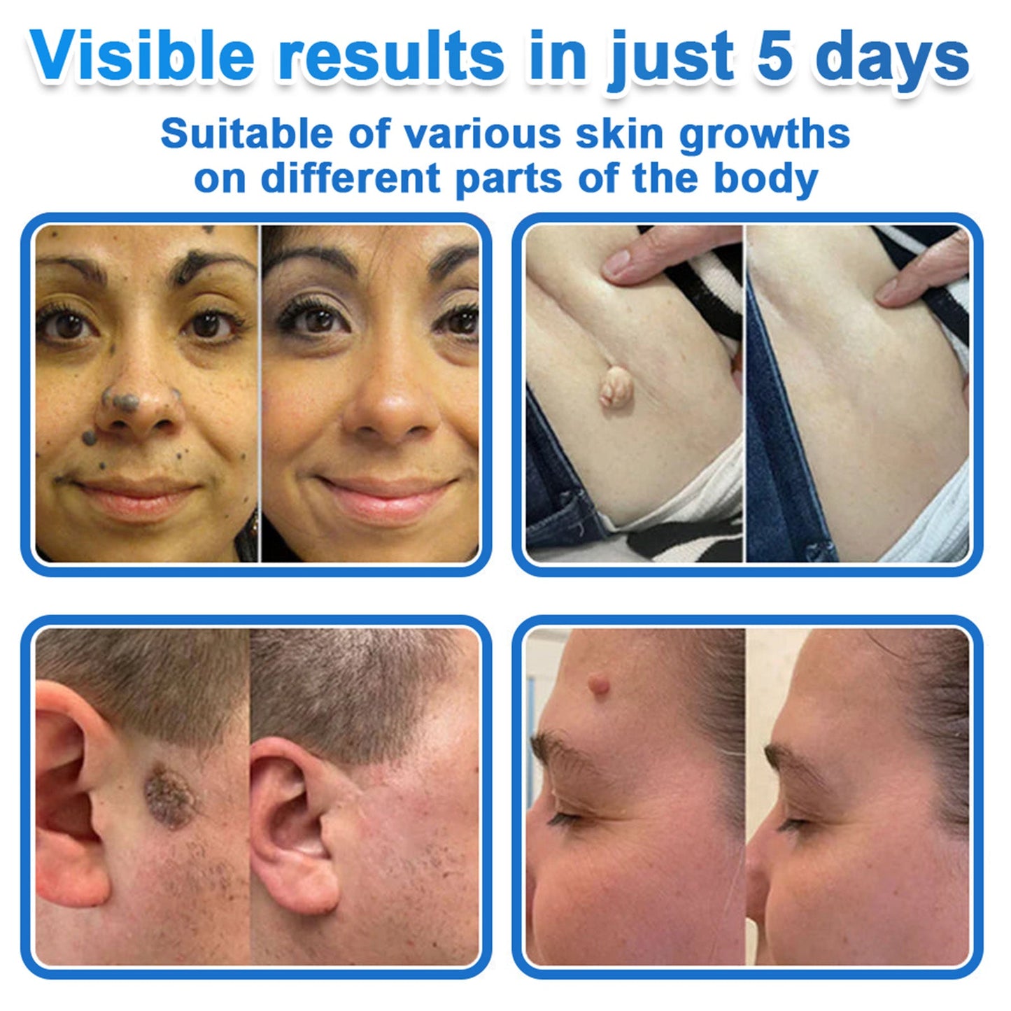 🩹 DR.Fachmer® 2-in-1 Microneedle & Hydrocolloid Patch | Raised Moles,Acne,  Flat Warts & Skin Tags Remover | Improves Wrinkles, Scars & Blemishes | Invisible Pimple Patches for Face & Body