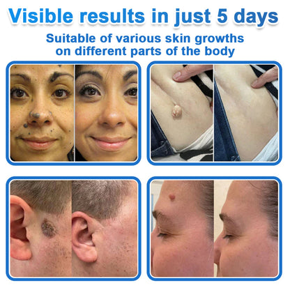 🩹 DR.Fachmer® 2-in-1 Microneedle & Hydrocolloid Patch | Raised Moles,Acne,  Flat Warts & Skin Tags Remover | Improves Wrinkles, Scars & Blemishes | Invisible Pimple Patches for Face & Body