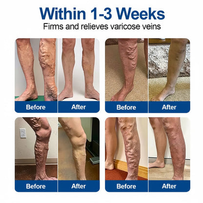 🇮🇪🍀🌳GFOUK® VeinTarget Microneedle Patch⚡Instant Relief, Long-Term Results