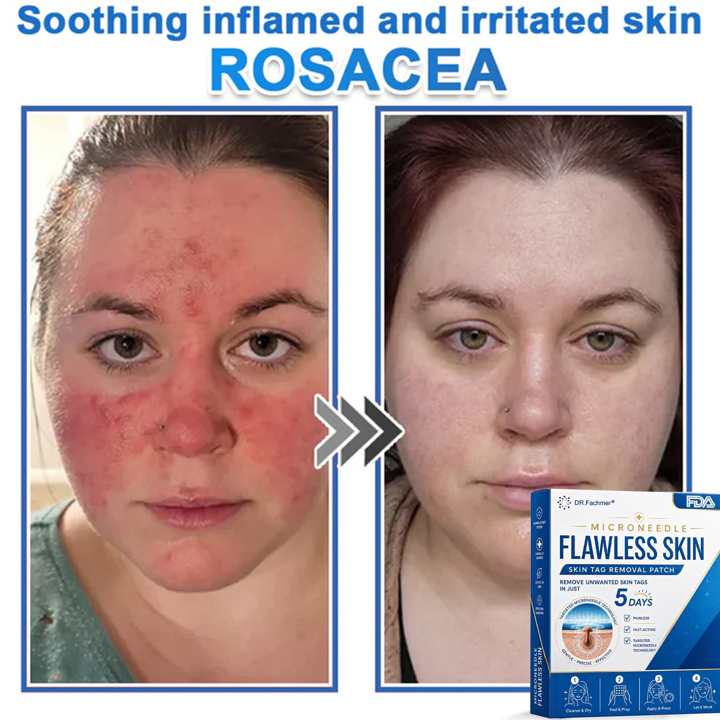 🩹 DR.Fachmer® 2-in-1 Microneedle & Hydrocolloid Patch | Raised Moles,Acne,  Flat Warts & Skin Tags Remover | Improves Wrinkles, Scars & Blemishes | Invisible Pimple Patches for Face & Body